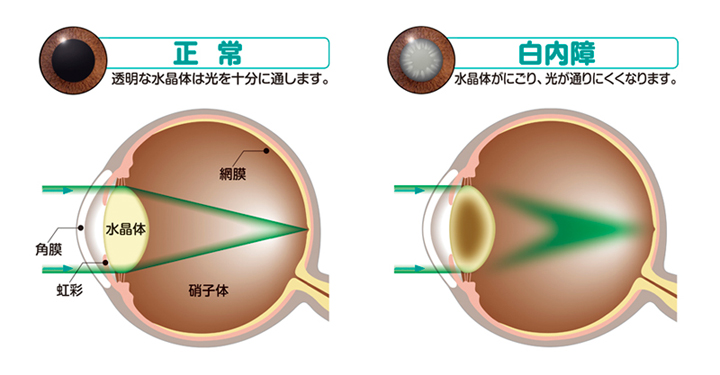 白内障とは