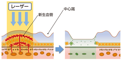 網膜光凝固術