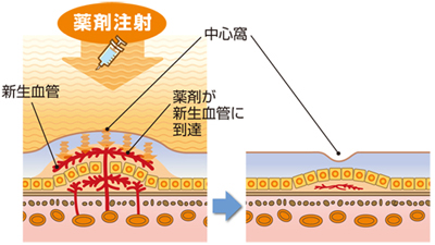 抗VEGF薬療法